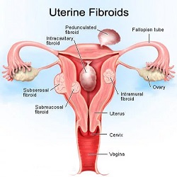 Uterine Fibroids External
