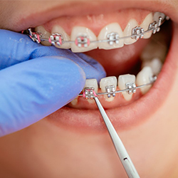 Orthodontic  Treatment (Alignment of teeth),Metal,Ceramic,Invisible Aligne