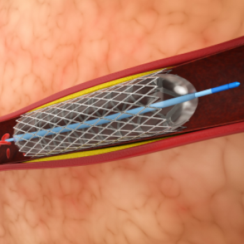 Angiography